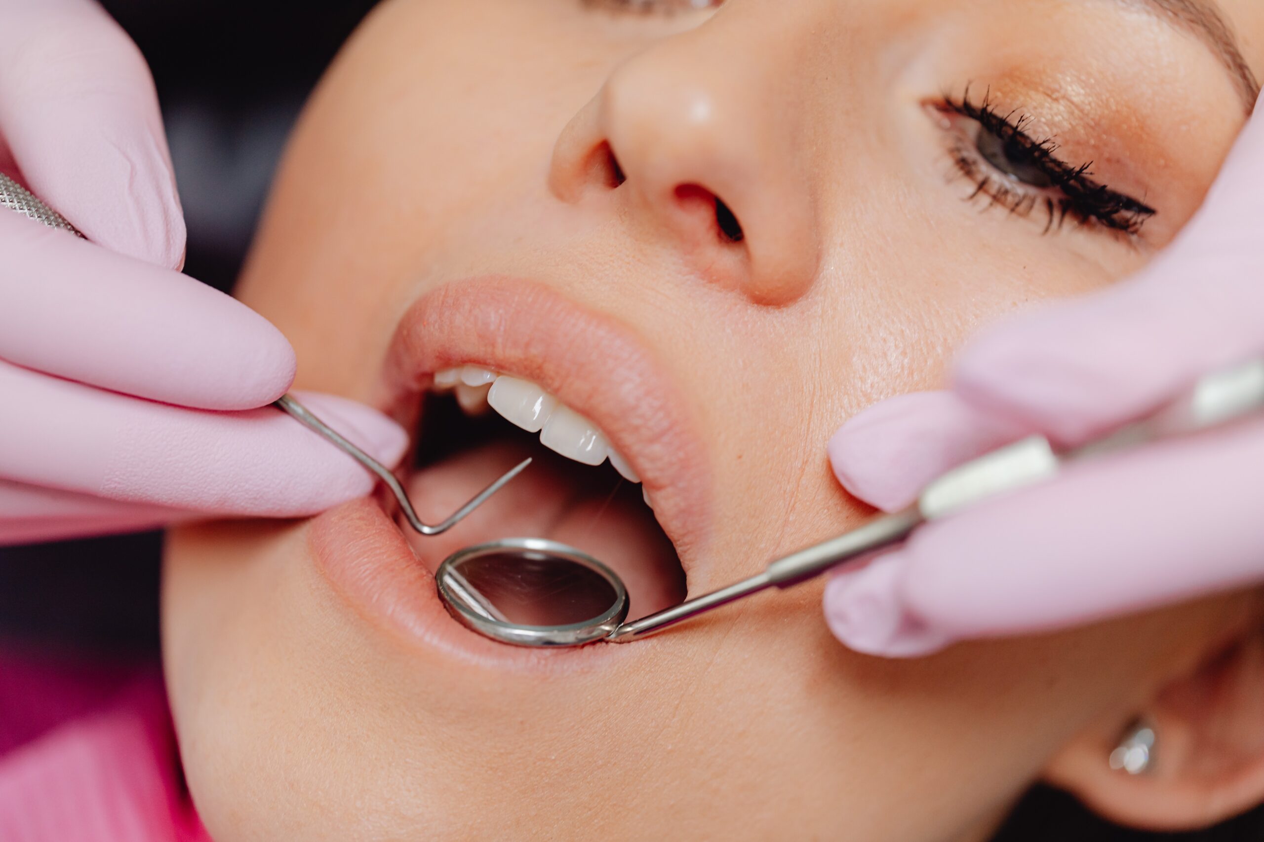 imagem de restauração dentária